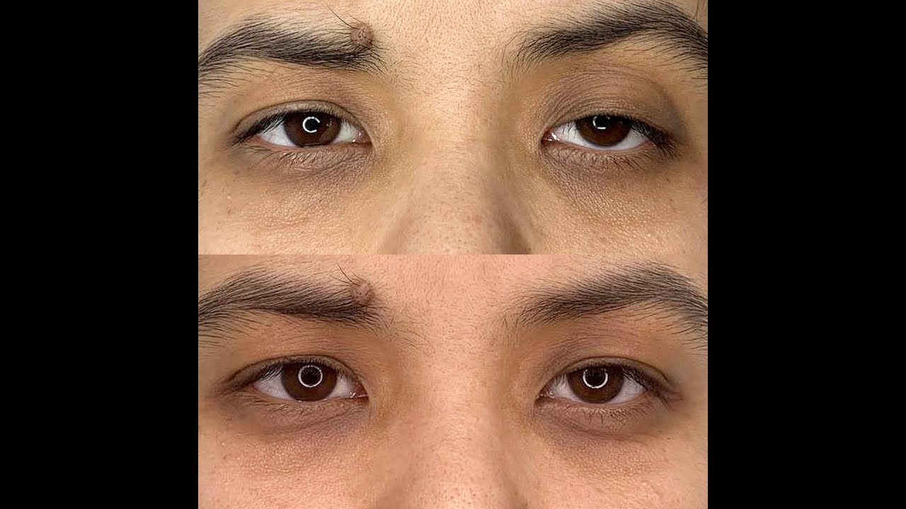 Устранение птоза верхнего века хирургическим путём. - YouTube