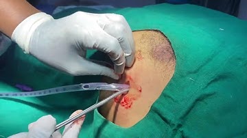ICD for left side pneumothorax