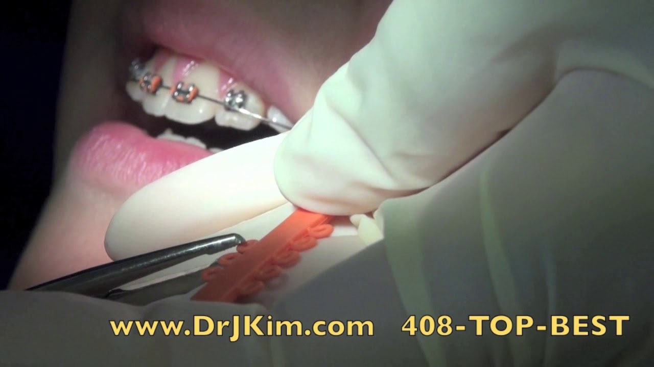 Best Family Orthodontist Dentist San Jose
