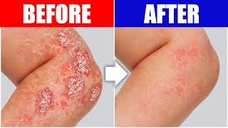 Psoriasis Relief: The Best Remedy For Your Skin