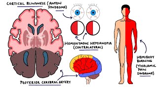 Posterior Cerebral Artery Stroke Syndromes | PCA Stroke Syndromes | Stroke Syndromes