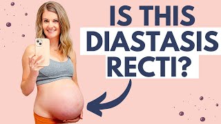 What Diastasis Recti Looks Like & Why It Happens