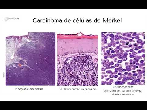 Carcinoma de células de Merkel
