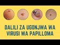 Dalili Za Ugonjwa Wa Virusi Wa Papilloma Unaosababisha Saratani Ya Mlango Wa Kizazi 