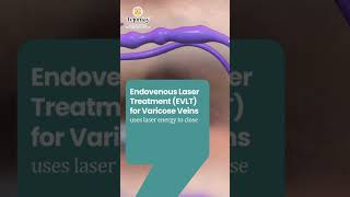 ✨ Say Goodbye to Varicose Veins with Advanced Endovenous Laser Treatment (EVLT)! ✨