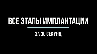 все этапы имплантации и протезирования за 30 секунд