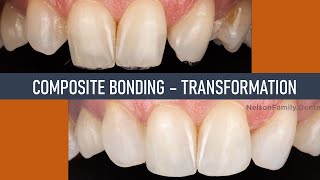 Composite Bonding for Missing Lateral Incisors!
