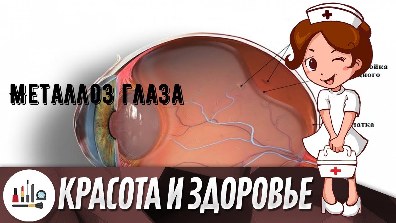 Металлоз глаза