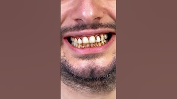 Before and after flossing