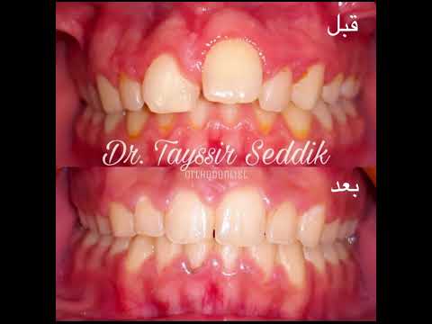 حالة تقدم في الفك العلوي وعدم تناظر سني وجهي تم علاجه بالتقويم الثابت خلال سنة ونصف تقريبا