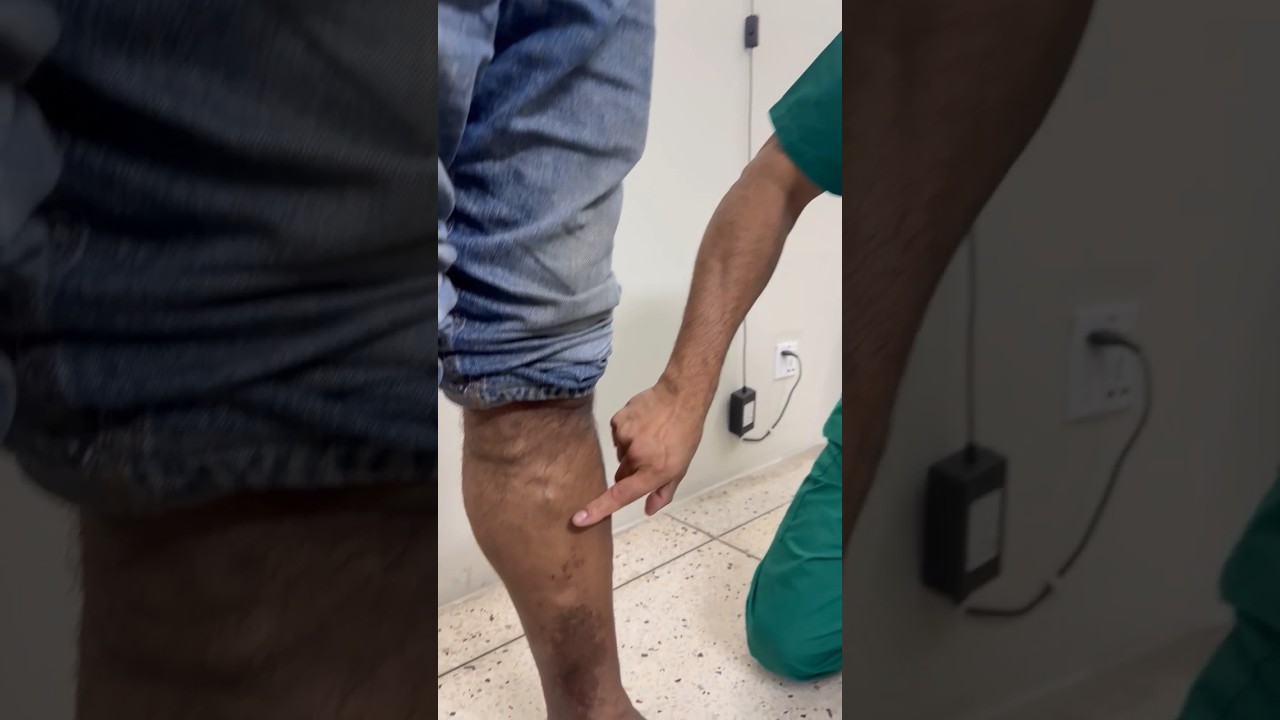 ⁣ভেরিকস ভেইনস থেকে হয়ে যেতে পারে মারাত্মক ক্ষতি!  #vericoseveins #vascular #healthtips #shorts