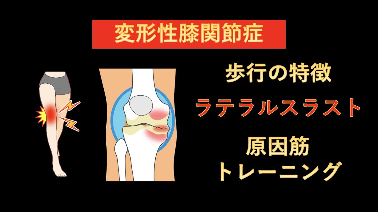 lateral thrust とは _ ラテラルスラスト 治療方法 – GQKWS