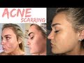 Treating my ACNE Scars II Treatments, skin care routine & supplements