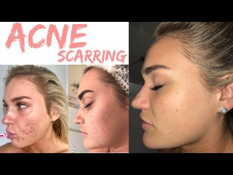 Treating my ACNE Scars II Treatments, skin care routine & supplements