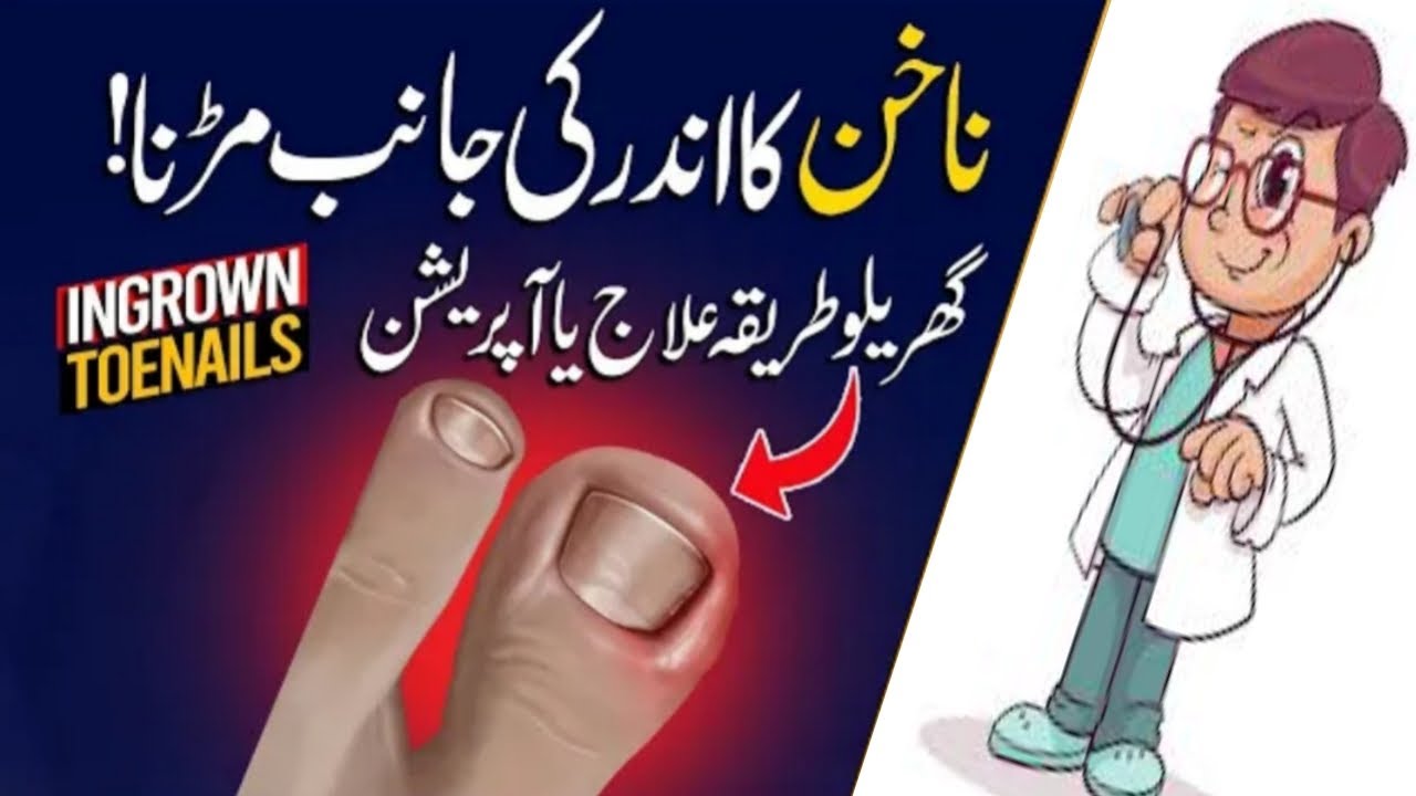 Ingrown Toenail Treatment In Urdu Hindi Ingrown Toenail Causes