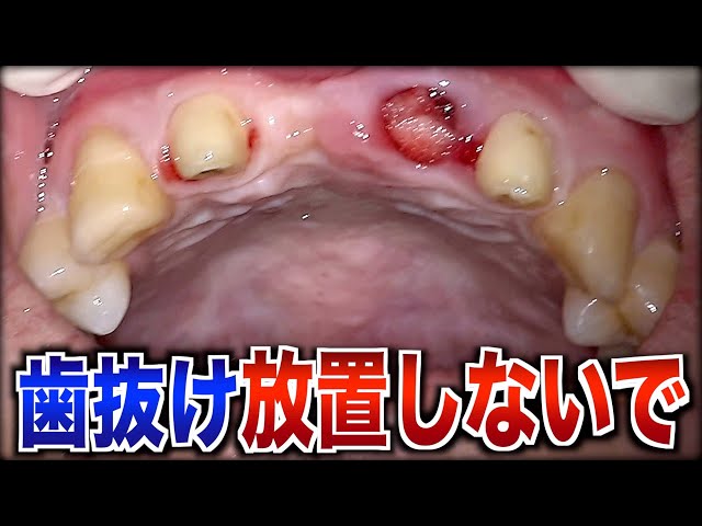 知らないと後悔する！歯が抜けた状態で放置する3つのデメリット - YouTube