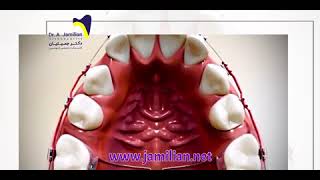 Class II Correction with Second Premolar Extraction