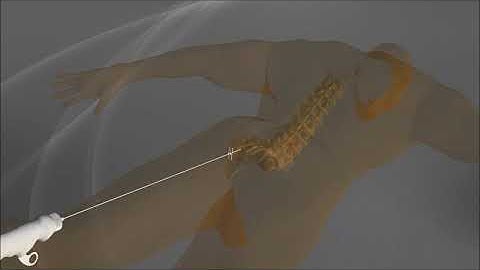 St. Reed-Steerable Neurolysis Catheter