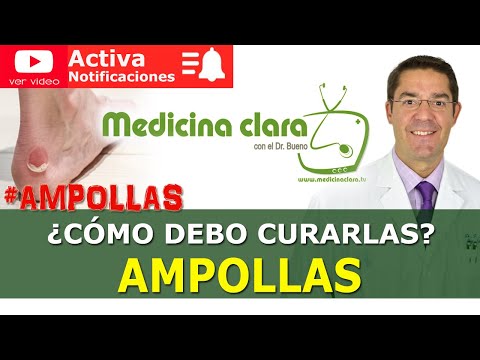 Video: Cómo secar las ampollas de edema: 11 pasos (con imágenes)