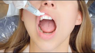Dental Vibe - Dental Injection Device