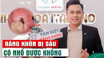 Răng Khôn Bị Sâu Có Nhổ Được Không?