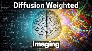 DWI MRI Scan Sounds Explained (Diffusion Weighted Imaging for Multiple Sclerosis) MS MRI Scan