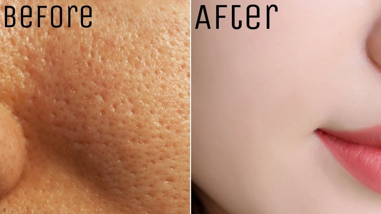  How To Close Open Pores From Face Easily At Home YouTube