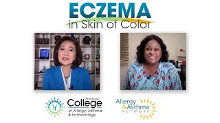 Diagnosing and Treating Eczema in Skin of Color