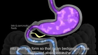 Sleeve Gastrectomy Procedure Animation screenshot 1