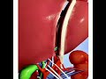 Liver Transplant Procedure @@ 3D animation Video @#@
