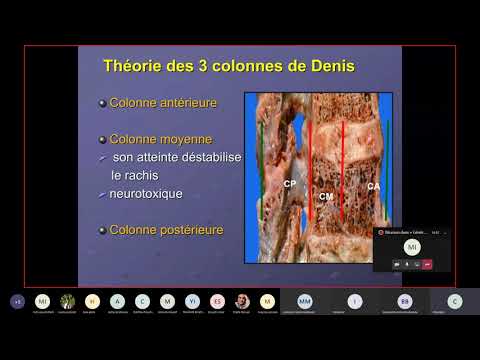 Vidéo: Comparaison Entre L'ostéosynthèse Sur Plaque Minimalement Invasive Et La Fixation Interne à Réduction Ouverte Pour Les Fractures Humérales Proximales: Une Méta-analyse Basée S