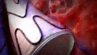 Percutaneous Approach To Abdominal Aortic Aneurysm Repair