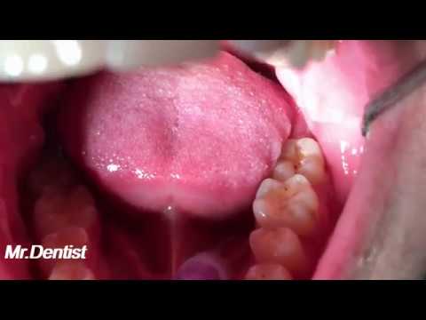 Video: Tooth Filling - Modern Methods Of Dental Filling