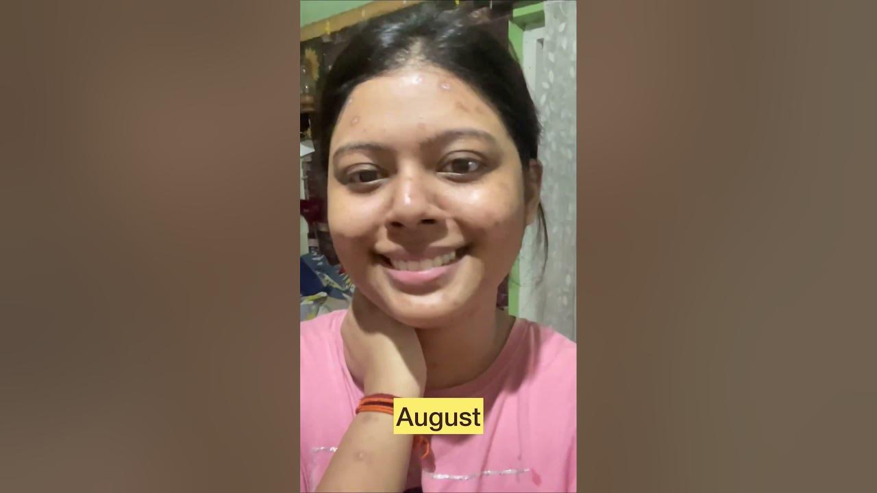 My #chickenpox #journey #remedy #oriflame #skincondition #skincare #shorts #shortvideo #viral