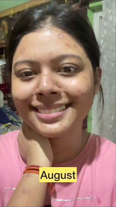 My #chickenpox #journey #remedy #oriflame #skincondition #skincare #shorts #shortvideo #viral