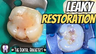 Replacing an Old Restoration While Preventing Recurrent Caries #C43 #4k