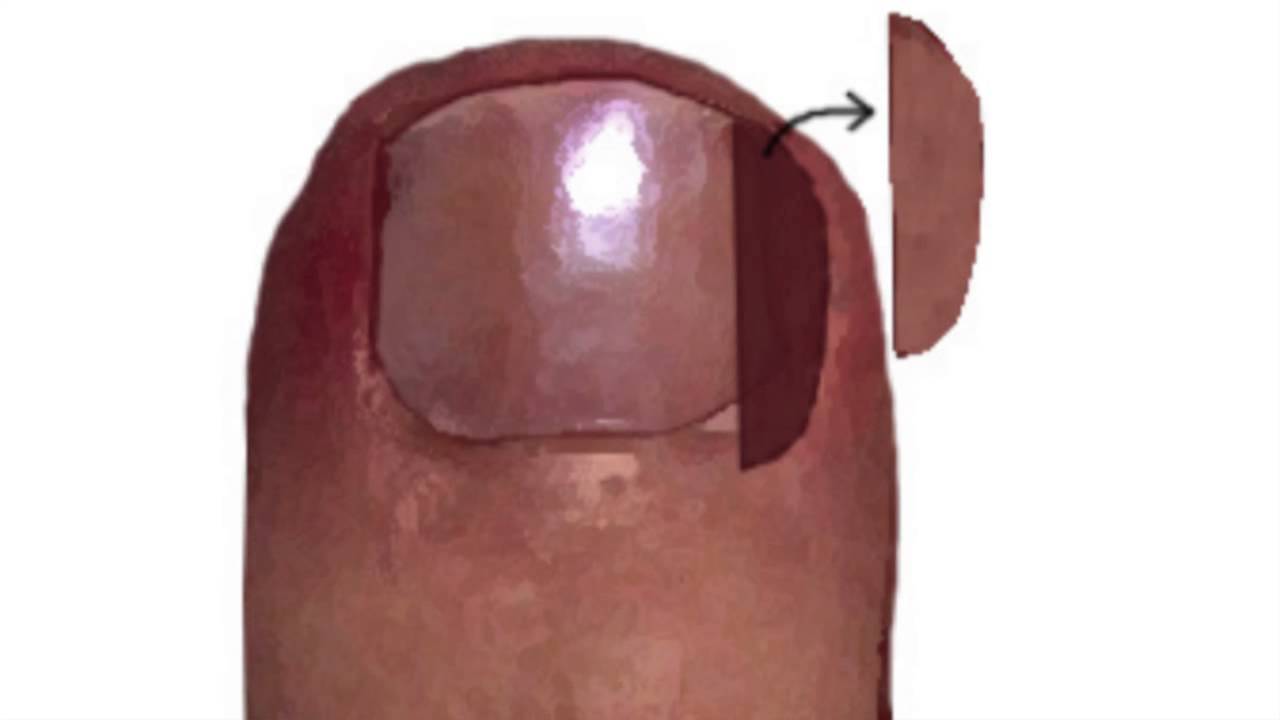 Painful Ingrown Nail Briarwood, Flushing, Melville, Queens