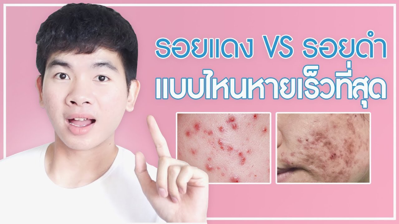 รอยแดง Vs รอยดำ รอยแบบไหนหายไวก่อนกัน | นุชา Happy Nucha - Youtube