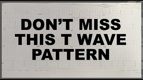 Paramedic ECG Breakdown (De-Winter's- T waves)