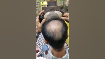 Best Clipping Hair Patch System | Delhihairfixing #hairpatch #hairtransplant #hairtechniques