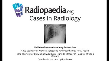 Unilateral tuberculous lung destruction (Radiopaedia.org) Cases in Radiology