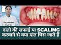 दांतो की सफाई कराने से क्या दांत घिस जाते हैं||Scaling Karvane Se Kya Dant Ghiste Hai||Tooth Scaling