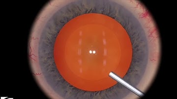 EyeSi CAT B Hydro Maneuvers, Level 1 (very soft lens, light attachment)