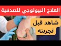 العلاج البيولوجي للصدفية وهل هو مؤلم و كيف ساعد الكثير في التعافي من الصدفية