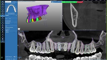 Hướng dẫn thiết kế máng cấy minivis với Realguide