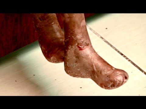 Vídeo: Dermatose Bolhosa Por IgA Linear Em Adultos E Crianças: Um Estudo Clínico E Imunopatológico De 38 Pacientes