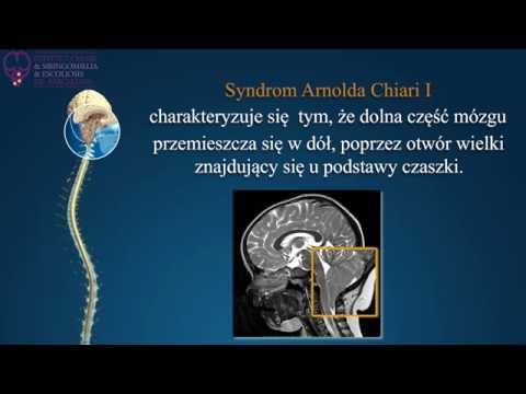 Wideo: Malformacja Arnolda-Chiariego - Leczenie, Operacja, Objawy