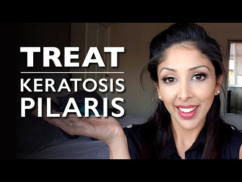 Video: Psoriasis Dan Keratosis Pilaris: Apa Perbedaannya?