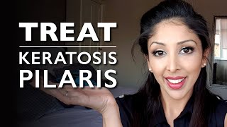 KERATOSIS PILARIS from DOCTOR V | KP Treatment |chicken skin | How to treat KERATOSIS PILARIS | DR V
