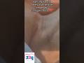 Heart #dancingcarotidartery #corriganspulse #heart #emergency #22q #veds #shorts #shortsvideo #short